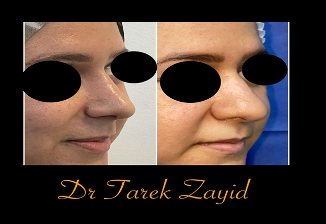 عمليات تجميل الأنف قبل وبعد
